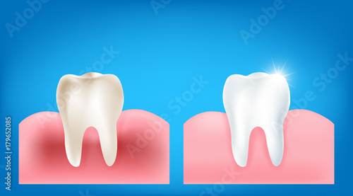 Collection of dirty tooth and gum compare with clean and strong  white tooth wiht glittering bright light element on blue background