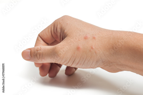 hand show sign of allergy isolated white background photo