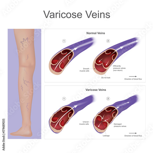 Varicose veins. Vein pressure have become enlarged and twisted on the leg, result from damaged blood pressure valves. Illustration.