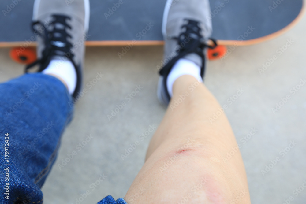 skateboarder injured legs while skateboarding on skatepark ramp