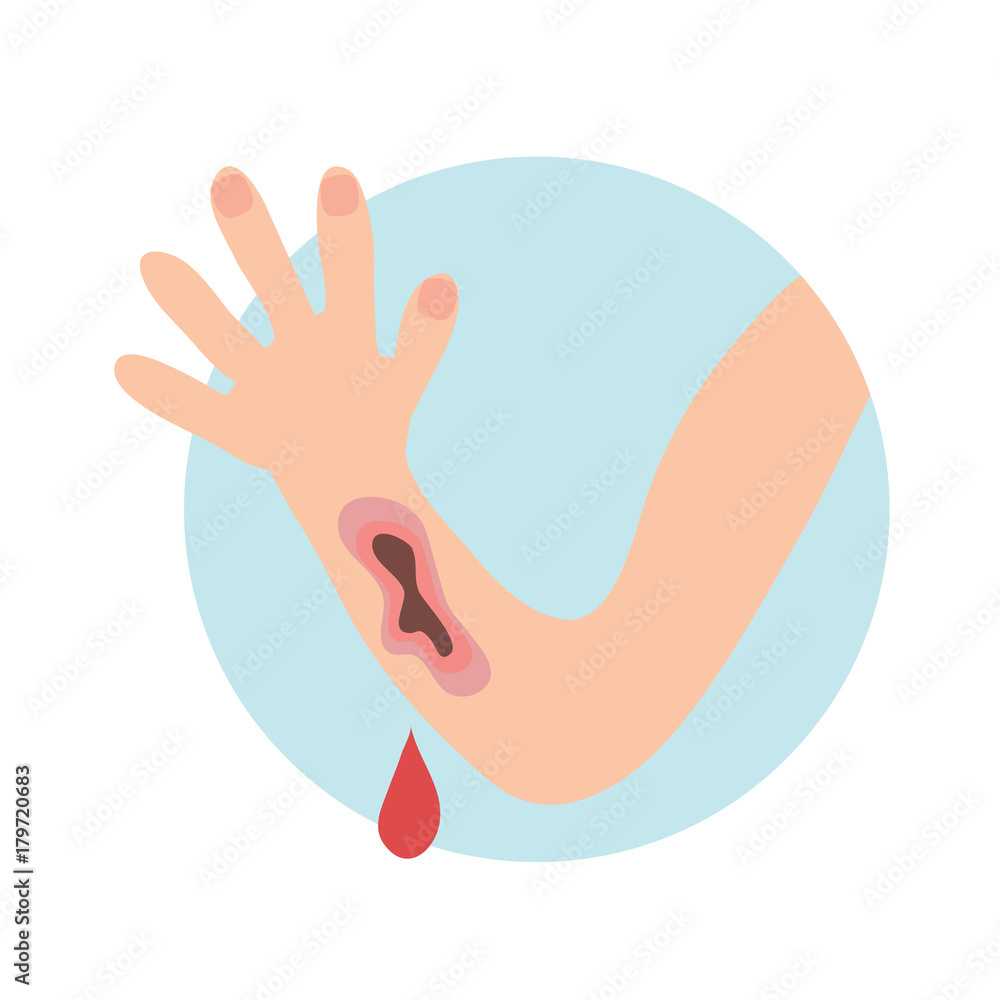 Wounded hand with blood oozing. Blood dripping down. Isolated flat illustration on white backgroud. Cartoon vector image. Wounded hand with blood oozing. Blood dripping down. Isolated flat illustration on white backgroud. Cartoon vector image.