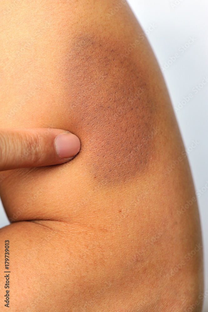 bruised and injured from domestic violence on female from retirement home or caretaker who has broken the trust as a legal health care concept bruised and injured from domestic violence on female from retirement home or caretaker who has broken the trust as a legal health care concept