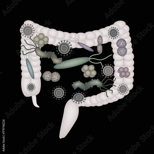 Dysbacteriosis of the intestine. The large intestine. dysbiosis of colon. Bacteria, fungi, viruses. Infographics. Vector illustration on black background.
