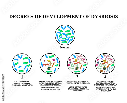 4 degrees of development of dysbiosis. Dysbacteriosis of the intestine. The large intestine. dysbiosis of colon. Bacteria, fungi, viruses. Infographics. Vector illustration on isolated background.