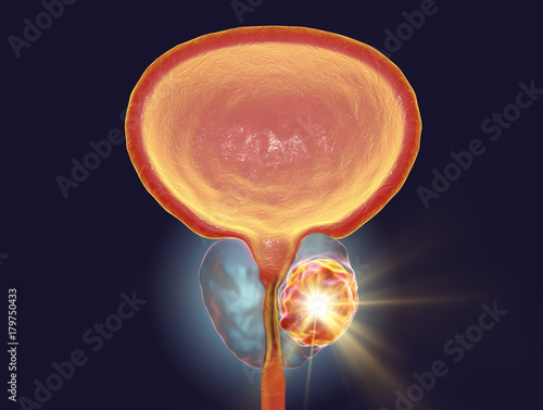 Conceptual image for prostate cancer treatment, 3D illustration showing destruction of a tumor inside prostate gland photo
