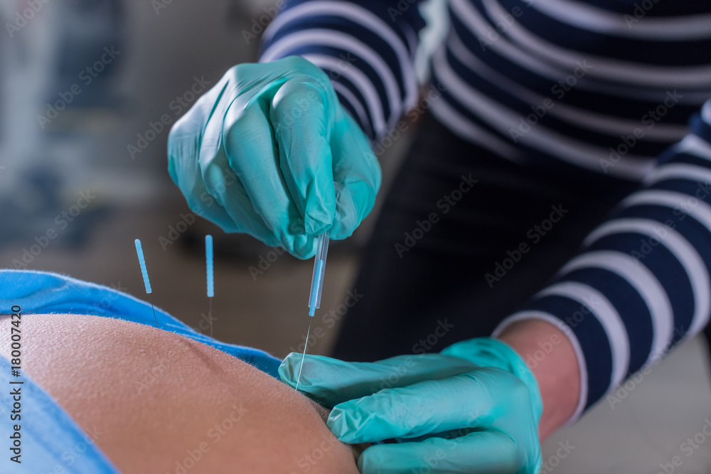 Dry Needling Therapy