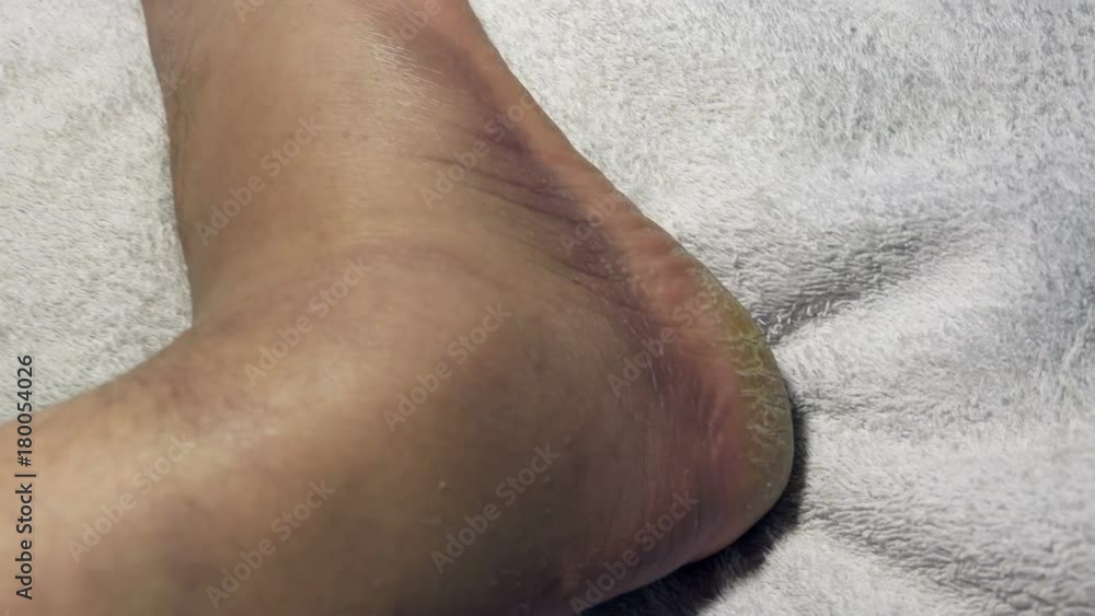 Top view of a male blue foot after stretching ligaments Top view of a male blue foot after stretching ligaments