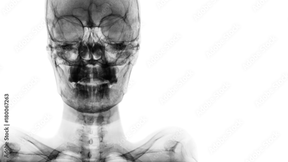 film x-ray Skull AP : show normal human's skull and blank area at right side
