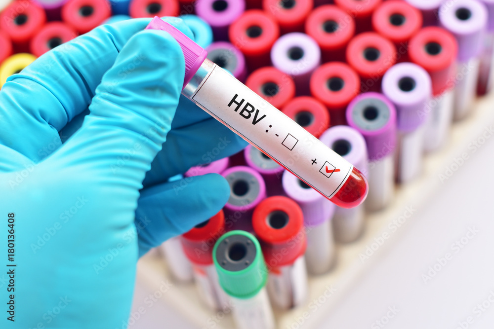 Fototapeta premium Blood sample positive with hepatitis B virus (HBV)
