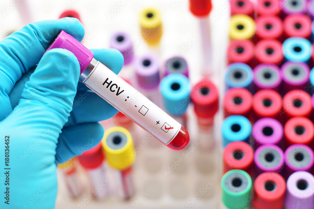 Fototapeta premium Blood sample positive with hepatitis C virus (HCV)