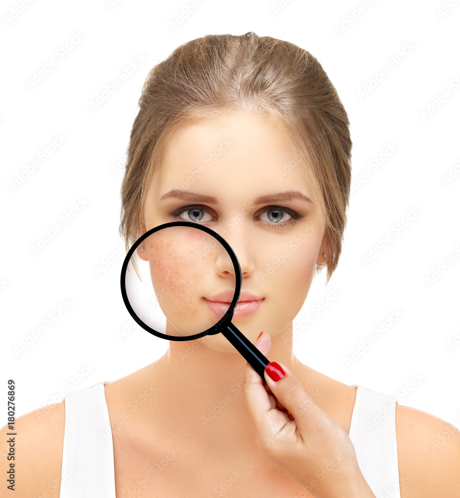 Post-Acne Marks /Treating Acne Scars Post-Acne Marks /Treating Acne Scars