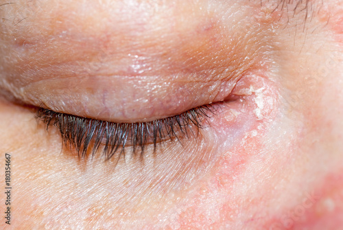 Psoriasis am auge photo