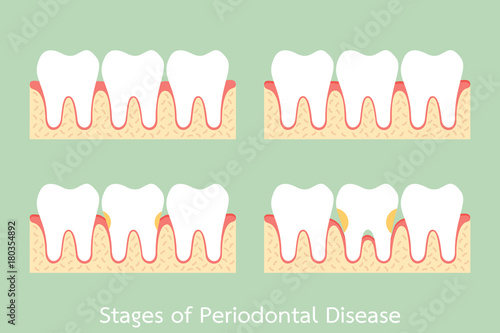 step of periodontal disease / periodontitis / gingivitis / gum disease, dental problem
