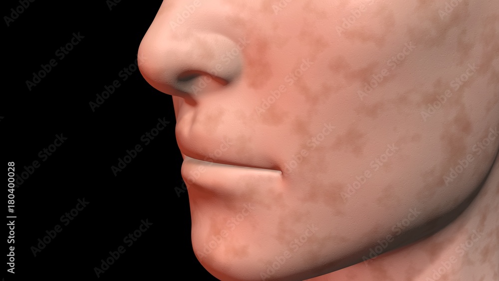 Face skin age spots medium surface color. 3d rendering Face skin age spots medium surface color. 3d rendering