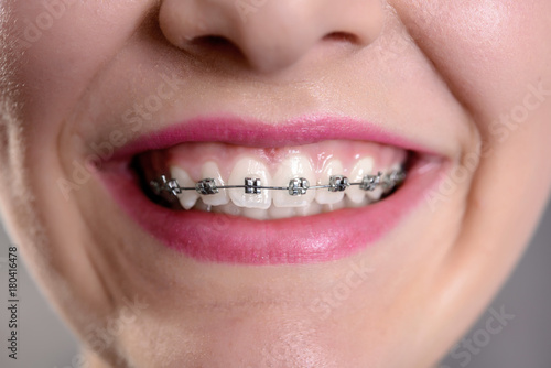 Quadro su tela smiling girl showing her fixed braces