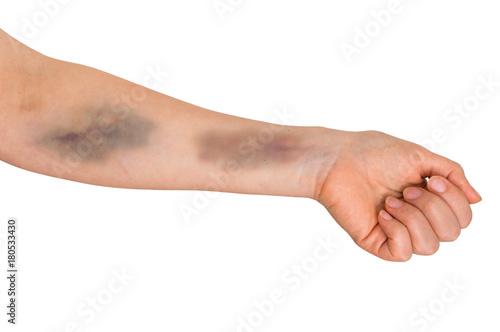 Fotografia Large bruise on human arm