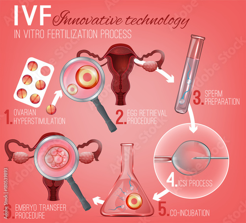 In Vitro Fertilization
