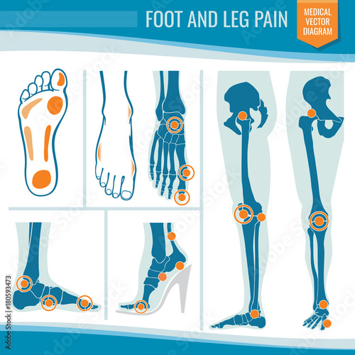 Foot and leg pain. Arthritis and rheumatism orthopedic medical vector diagram