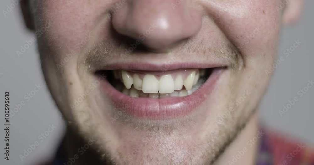 The man is smiling. Crooked teeth needing braces. The man is smiling. Crooked teeth needing braces.