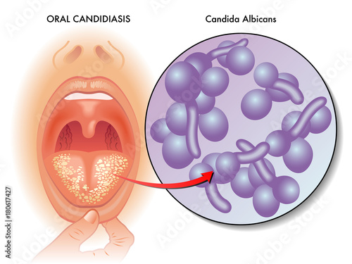 vector medical illustration of the symptoms of oral candidiasis