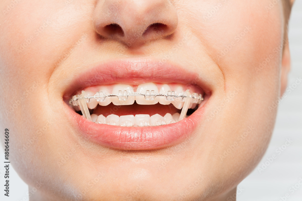 Female mouth with orthodontic elastics on braces Female mouth with orthodontic elastics on braces