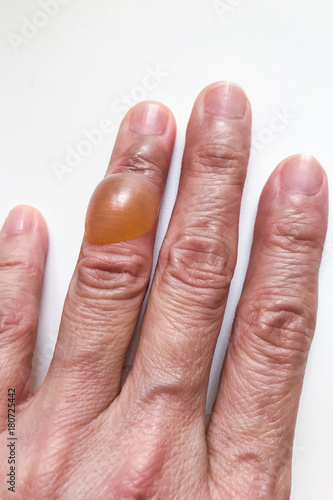 Close-up on finger with painful inflammed fluid-filled blister