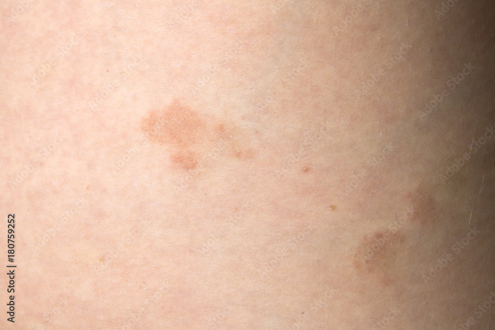 Pityriasis rosea three weeks after the appearance of the first focus on the skin of a young woman. A pink lichen is an approximation on the thigh. Gibera Syndrome Pityriasis rosea three weeks after the appearance of the first focus on the skin of a young woman. A pink lichen is an approximation on the thigh. Gibera Syndrome
