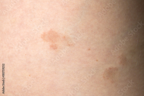 Pityriasis rosea three weeks after the appearance of the first focus on the skin of a young woman. A pink lichen is an approximation on the thigh. Gibera Syndrome