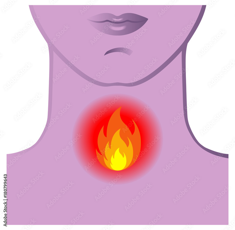 symbolic medical illustration of the symptoms of burning throat Stock