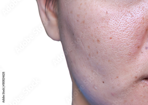 Woman 's problematic skin , acne scars ,oily skin and pore, dark spots and blackhead and whitehead on the face.