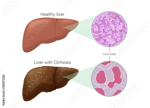 The difference of Healthy liver cells and Cirrhosis. Illustration about symptom of disease.