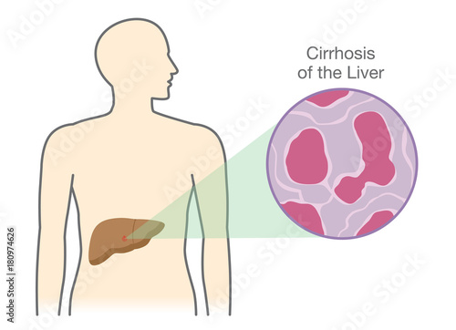 Showing damaged cells at the liver of Cirrhosis people. Illustration about medical and health concept.