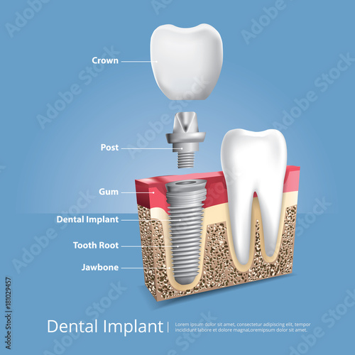 Human teeth and Dental implant Vector Illustration