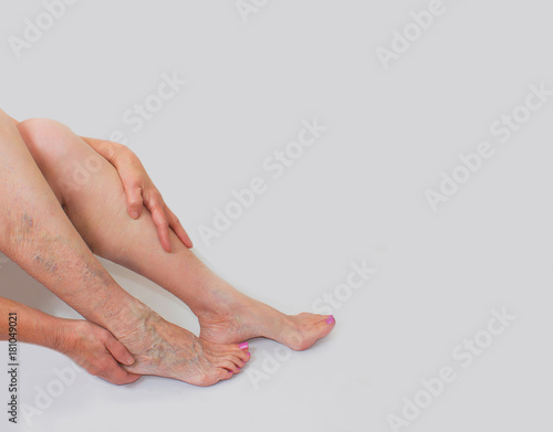 Varicose veins on a female legs © Solarisys
