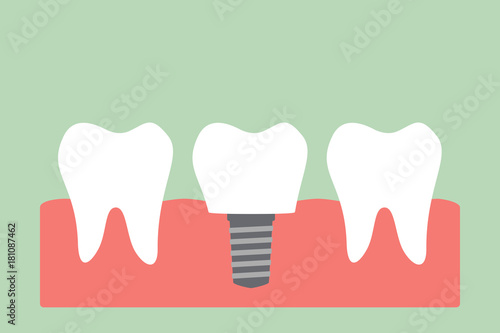 dental implant with crown