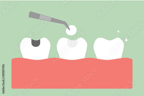 tooth amalgam filling with dental tools