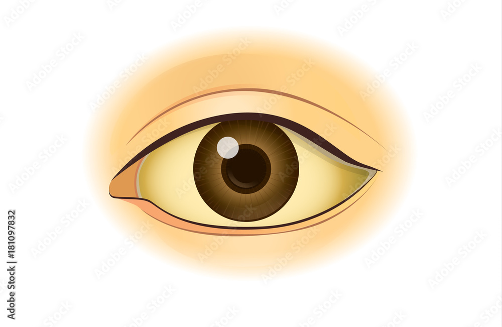 Yellowing in the human eye. Illustration about symptom from digestion