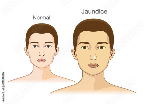 The Comparison between normal skin people and yellowing from Jaundice. Illustration about health problems condition.