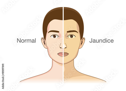 The Comparison between normal skin people and yellowing from Jaundice. Illustration about health problems condition.