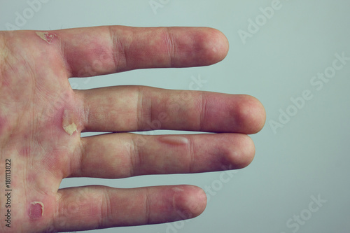 Canvas-taulu Hands with blister and callus