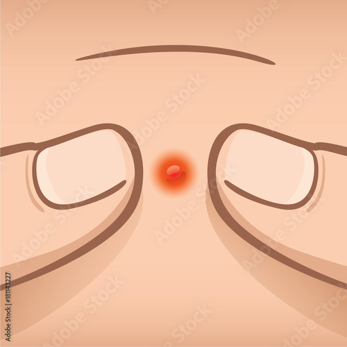 Illustration first aid of fingers squeezing an acne, Caucasian. Ideal for medical, informative and institutional catalogs