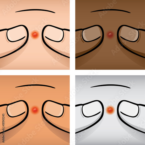 Illustration first aid of fingers squeezing an acne, ethnicities. Ideal for medical, informative and institutional catalogs