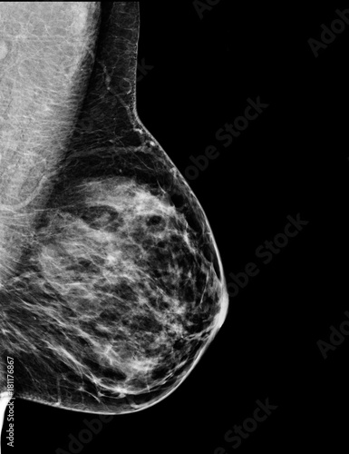 Mammography Exam