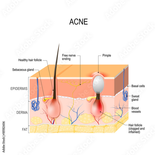 Acne vulgaris. pimple.