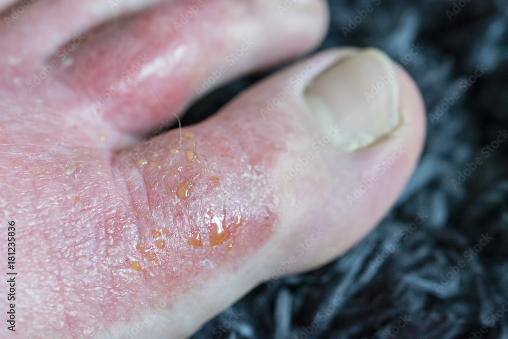Eczema wetting - Skin disease on the foot of the foot. Eczema wetting - Skin disease on the foot of the foot.