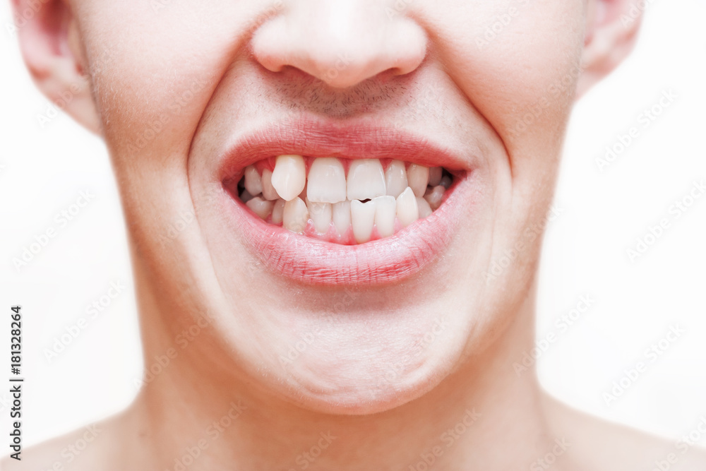 Fototapeta premium Young man showing crooked growing teeth. The man needs to go to the dentist to install braces.