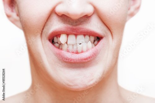 Young man showing crooked growing teeth. The man needs to go to the dentist to install braces.