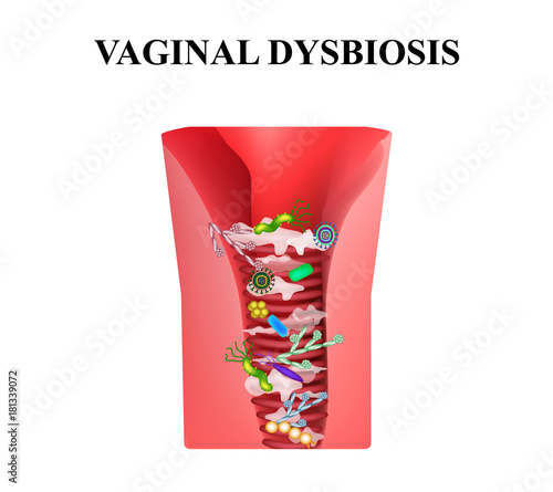 Vaginal dysbiosis. Dysbacteriosis of the vagina. Vaginitis Candidiasis. Lactobacillus, bifidobacteria. Bacteria pathogenic flora. Infographics. Vector illustration on isolated background