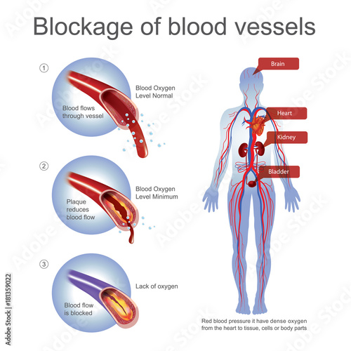 Blockage of blood Vessels. Red blood pressure it have dense oxygen from the heart to tissue, cells or body parts. Unconscious it caused by blood oxygen level minimum or lack of oxygen.