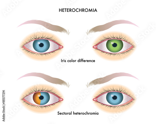 vector medical illustration of the symptoms of heterochromia photo
